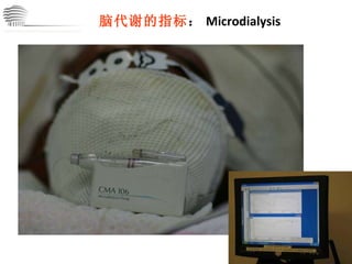 CHINA International Neuroscience Institute ICU 脑代谢的指标 ： Microdialysis 评估 治疗 监测 