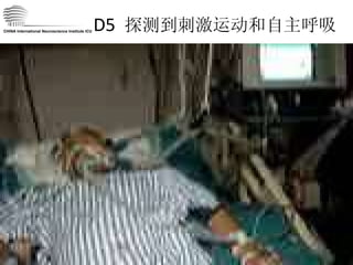 D5  探测到刺激运动和自主呼吸 CHINA International Neuroscience Institute ICU 