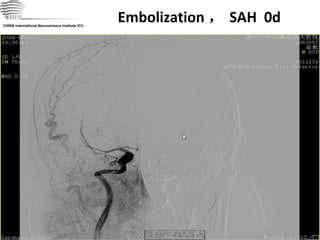 Embolization ， SAH  0d CHINA International Neuroscience Institute ICU 