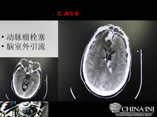 　  case 动脉瘤栓塞 脑室外引流 