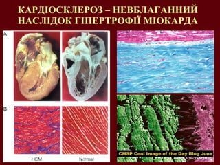 КАРДІОСКЛЕРОЗ – НЕВБЛАГАННИЙ НАСЛІДОК ГІПЕРТРОФІЇ МІОКАРДА 