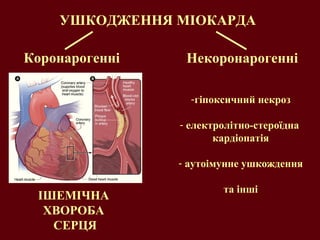 УШКОДЖЕННЯ МІОКАРДА Коронарогенні Некоронарогенні гіпоксичний некроз електролітно-стероїдна  кардіопатія аутоімунне ушкождення та   інші ІШЕМІЧНА  ХВОРОБА  СЕРЦЯ 