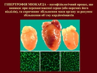 ГІПЕРТРОФІЯ МІОКАРДА – патофізіологічний процес, що виникає при перевантаженні серця (або окремих його відділів), та спричинює збільшення маси органу за рахунок збільшення об ` єму кардіоміоцитів 