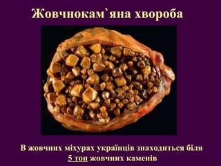 Жовчнокам ` яна хвороба В жовчних міхурах українців знаходиться біля  5 тон  жовчних каменів 