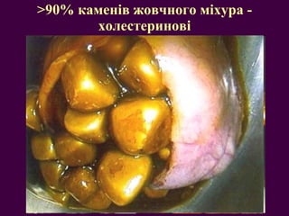 > 90% каменів жовчного міхура - холестеринові 