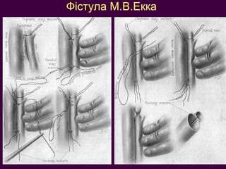 Фістула М.В.Екка 