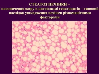 СТЕАТОЗ ПЕЧІНКИ –  накопичення жиру в цитоплазмі гепатоцитів – типовий наслідок ушкодження печінки різноманітними факторами 