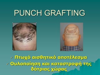  Αυξάνονται ραγδαία οι επεμβάσεις αποκατάστασης του τριχωτούΠΑΛΑΙΕΣ ΜΕΘΟΔΟΙ ΑΠΟΚΑΤΑΣΤΑΣΗΣPunch grafting- “plug” hair grafts
