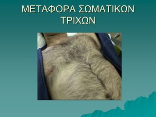 FUE (Follicular Unit Extraction)