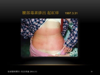 紅斑性狼瘡  案例1女，17歲，就讀中山女高二年級，因關節痛去醫院檢查，結果為紅斑性狼瘡初期發作，介紹來本中心時，剛開始服用低劑量類固醇，個人認為這是處理的黃金時機。福濬醫療體系- 院長會議 2011.5.18