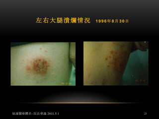 林小姐第一次來中心時，由她母親陪同，先前電話告之務必請家人陪同前來，因家人的了解與支持，共同配合才是成效的關鍵。當面溝通個人研究的理論和處理方法，分析因果關係，預估其療程分階段至少要10年，才能改變體質，恢復正常。在她同意配合下，外敷手肘第一次後，隔天潰爛傷口處竟癒合結痂，周圍親友都為她高興，燃起了更大的信心及盼望！福濬醫療體系- 院長會議 2011.5.119