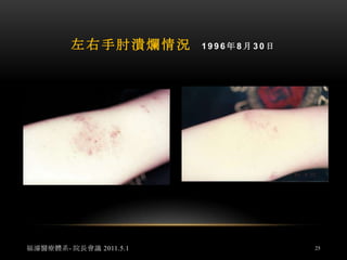            第一次外敷膝蓋腳踝情況      1996.8.30福濬醫療體系- 院長會議 2011.5.123