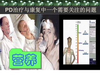 PD治疗与康复中一个需要关注的问题




 营养
 
