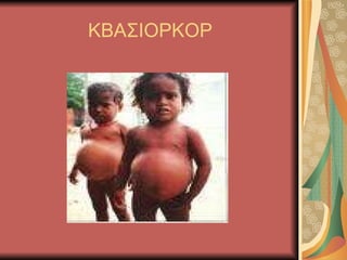 ΚΒΑΣΙΟΡΚΟΡ 