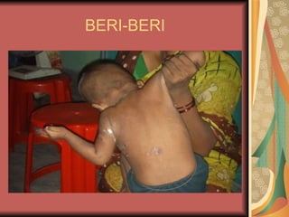 BERI-BERI 