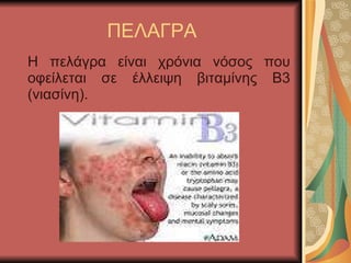 ΠΕΑΓΡΑ Η πελάγρα είναι χρόνια νόσος που οφείλεται σε έλλειψη βιταμίνης Β3   (νιασίνη) . 