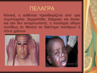 ΠΕΑΓΡΑ Κλινικά, η ασθένεια προσδιορίζεται από τρία συμπτώματα- δερματίτιδα, διάρροια και άνοια- και εάν δεν αντιμετωπιστεί, η πελλάγρα οδηγεί συνήθως σε θάνατο σε διάστημα τεσσάρων ή πέντε χρόνων.  