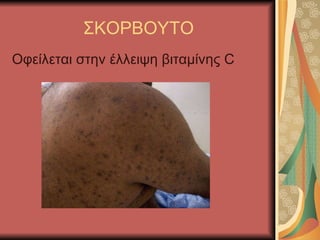 ΣΚΟΡΒΟΥΤΟ Οφείλεται στην έλλειψη βιταμίνης C  