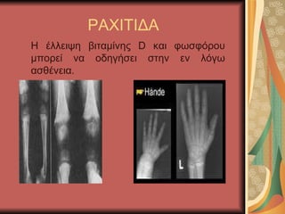 ΡΑΧΙΤΙΔΑ Η έλλειψη βιταμίνης  D  και φωσφόρου μπορεί να οδηγήσει στην εν λόγω ασθένεια. 
