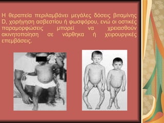 Η θεραπεία περιλαμβάνει μεγάλες δόσεις βιταμίνης D, χορήγηση ασβεστίου ή φωσφόρου, ενώ οι οστικές παραμορφώσεις μπορεί να χρειασθούν ακινητοποίηση σε νάρθηκα ή χειρουργικές επεμβάσεις. 