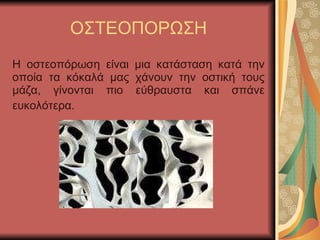 ΟΣΤΕΟΠΟΡΩΣΗ Η οστεοπόρωση είναι μια κατάσταση κατά την οποία τα κόκαλά μας χάνουν την οστική τους μάζα, γίνονται πιο εύθραυστα και σπάνε ευκολότερα.   