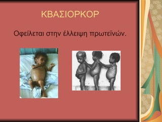 ΚΒΑΣΙΟΡΚΟΡ Οφείλεται στην έλλειψη πρωτεϊνών. 
