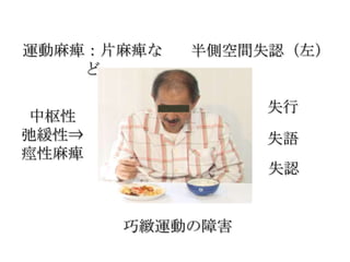運動麻痺：片麻痺な   半側空間失認（左）
    ど

                 失行
 中枢性
弛緩性⇒             失語
痙性麻痺
                 失認


       巧緻運動の障害
 