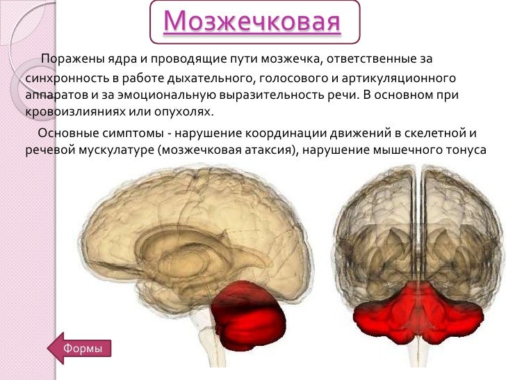 Моторная дизартрия это