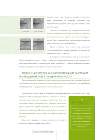 выражение вашего лица. Это вызывает расслабление мимических

                                           мышц,    предотвращает     их   чрезмерное      сознательное      или

                                           подсознательное сокращение, а кожа над ними становится снова

                                           мягкой и гладкой.

                                               Чаще всего он применяется для устранения горизонтальных
   До лечения         После лечения
                                           морщин на лбу, вертикальных морщин над корнем носа, морщинок

                                           возле глаз или в сочетании с другими эстетическими процедурами

                                           на лице. Реже он применяется для удаления мелких морщинок на

                                           других участках лица, шеи и области декольте.

                                               Терапия с ботоксом также помогает при повышенном

                                           потоотделении в области подмышек, ладоней и стоп. В этом случае
   До лечения         После лечения
                                           эффект длится около 6 – 12 месяцев.

                                               Сеанс терапии с ботулинотоксином токсином на лице, шее или

области декольте длится около 10 – 15 минут. В течение этого времени, наши специалисты, через маленькую иглу,

вводят небольшое количество токсина ботулина. Эффект длится около 4 – 6 месяцев. Введение ботокса можно

повторять многократно, через определенные временные интервалы.


  Применение натуральных наполнителей для разглажива-
ния морщин на лице – гиалуроновая кислота
    Гиалуроновая кислота – это вещество, которое в естественных условиях присутствует в организме. Процедура

с гиалуроновым препаратом позволит Вам разгладить морщины там, где Вы этого желаете (губы, щеки, складки

на подбородке и т.д.) и подкорректировать возможные рубцы на коже.



    Процедура длится около 20 минут. За это время, врач вводит в желаемые места натуральный продукт в виде

прозрачного геля. Он совершенно безопасен, изготовлен из вещества,

полностью идентичного присутствующему в человеческом теле, и не

представляет никакого повышенного риска появления аллергической                   Это интересно знать

реакции. Длительность эффекта варьируется от 6 до 12 месяцев, в
                                                                                 Гиалуроновая кислота – составная
зависимости от вида препарата. В последнее время появились наполнители               часть любой ткани нашего
на основе гиалуроновой кислоте, которые дают эффект длительностью                  организма. Ее основная задача

более года.                                                                      состоит в удержании воды в тканях,
                                                                                   доставке питательных веществ
    Сразу после процедуры, с хорошим настроением, Вы сможете
                                                                                    к клеткам и одновременном
вернуться к своим повседневным делам и работе.                                    выведении конечных продуктов
                                                                                           обмена веществ.


                    Красота и здоровье                           1 0
 