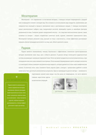 Мезотерапия
                         Мезотерапия – это современная и естественная методика, с помощью которой поврежденной и увядшей

                    коже возвращается свежий и молодой вид. Она основана на использовании ряда продуктов, применяемых для

                    поверхностных инъекций в процессе омоложения кожи и разглаживания морщин. С помощью мезотерапии

                    можно дополнительно снабдить кожу гиалуроновой кислотой, являющейся одним из важнейших факторов

                    увлажненности кожи. Снижение уровня гиалуроновой кислоты – это следствие многочисленных причин, самые

                    основные из которых – возраст, воздействие солнечных лучей, курение, изменения гормонального фона.

                    Мезотерапия повторно увлажняет кожу, улучшает ее тонус и эластичность, а также эффективно разглаживает

                    морщины. Данная процедура выполняется на лице, шее, области декольте и руках.



                         Радиаж
                         Радиаж является неинвазивным, нежным, безопасным и эффективным, клинически протестированным

                    методом омоложения кожи лица, шеи и области декольте. В данном методе используется радиочастотная

                    система, вызывающая нагревание подкожной ткани. Тепло заставляет раздвигаться коллагеновые волокна, а при

                    охлаждении кожи они снова сжимаются как пружина. Тепло вызывает формирование нового, молодого коллагена

                    и, в некоторой степени, вымывает внутриклеточную жидкость, которая удаляется из ткани через лимфатические

                    каналы. В конечном итоге, кожа становится более упругой. Даже у женщин с чрезвычайно дряблой и вялой

                    кожей могут быть достигнуты великолепные результаты. Одно из преимуществ данного метода — возможность

                                        подтягивания нежной кожи вокруг глаз без риска ее повреждения, что часто является

                                        главным недостатком других
Это интересно знать                     косметических операций.

 Радиаж является уникальным и
  самым современным методом
 омоложения. Данная процедура
                                                                            До лечения        После лечения
может выполняться на всех типах
кожи, а результаты заметны сразу
по ее окончании – кожа становится
   упругой, глубокие морщины
разглаживаются, а полный эффект
  достигается через три месяца.




                                          1 1                  m e d i c a l         c e n t e r        R O G A Š K A
 