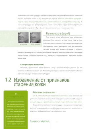 омоложением своей кожи. Процедура, не требующая предварительной противоболевой терапии, разглаживает

                      морщины, подправляет изъяны на лице и придает коже упругость. Сочетание использования радиочастот и

                      лазерной энергии стимулирует образование новых коллагеновых волокон, что придает коже молодой вид. По

                      окончании процедуры, кожа приобретает розовый, свежий и более упругий вид. Для достижения длительного

                      результата, обычно требуется от 3 до 5 сеансов, в зависимости от состояния и текстуры вашей кожи.



                                                                      Лечение акне (угрей)
                                                                      Акне являются частым заболеванием кожи, доставляющим

                                                                  дискомфорт. Они появляются на лице, плечах, груди и спине.

                                                                  Избыточное количество кожного сала и отмершей ороговевшей кожи
                          До лечения        После лечения
                                                                  накапливается и создает благоприятную среду для размножения

                                                                  бактерий, которые могут вызывать воспаление. В результате

                      появляются видимые угри. Из-за глубокого воспаления, на коже могут навсегда остаться рубцы. В медицинском

                      центре «Рогашка», с помощью технологии ELOS™ предлагается суперсовременная и эффективная методика

                      лечения угрей.


                          Как проводится лечение?
                          Оптическая и радиочастотная энергия проникает в кожу и уничтожает бактерии, уменьшая при этом

                      воспаление и образование кожного сала. Количество рекомендуемых сеансов зависит от степени болезни;

                      результатом процедуры является чистая кожа без угрей.



1.2 Избавление от признаков
    старения кожи
                                                Химический пилинг
                                                Если Вы хотите избавиться от поверхностных изменений на коже, возникших из-за
 Это интересно знать
                                           длительного воздействия солнечных лучей и искусственных источников УФ - излучения,
 С помощью химического пилинга             уменьшить морщины и удалить пигментные пятна, то к Вашим услугам химический пилинг.
 лица можно уменьшить морщины
                                                При данной популярной косметической процедуре, с помощью химических растворов
 везде, кроме носогубных складок
                                           различной концентрации и химических форм, удаляются слои клеток, а также оказывается
(которые идут от носа вниз к уголкам
  рта). Для достижения наилучших           воздействие на образование коллагена в глубоких слоях кожи.
  результатов, рекомендуется еще
несколько месяцев после процедуры
 избегать солнечного воздействия
 и использовать рекомендованные            Красота и здоровье                           8
   врачом средства защиты кожи.
 