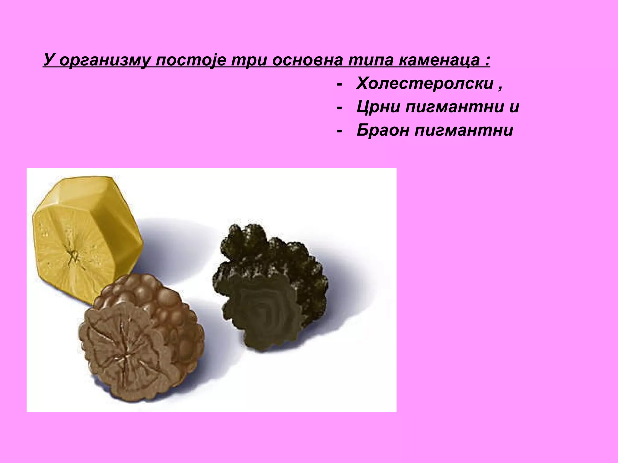 У организму постоје три основна типа каменаца :   -  Холестеролски , -  Црни пигмантни и  -  Браон пигмантни   