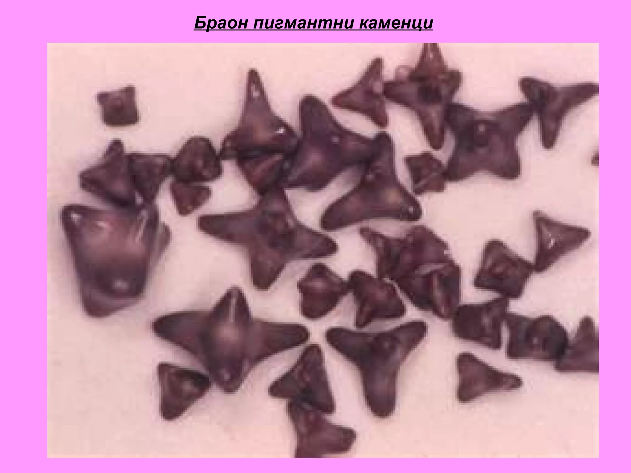 Браон пигмантни каменци 