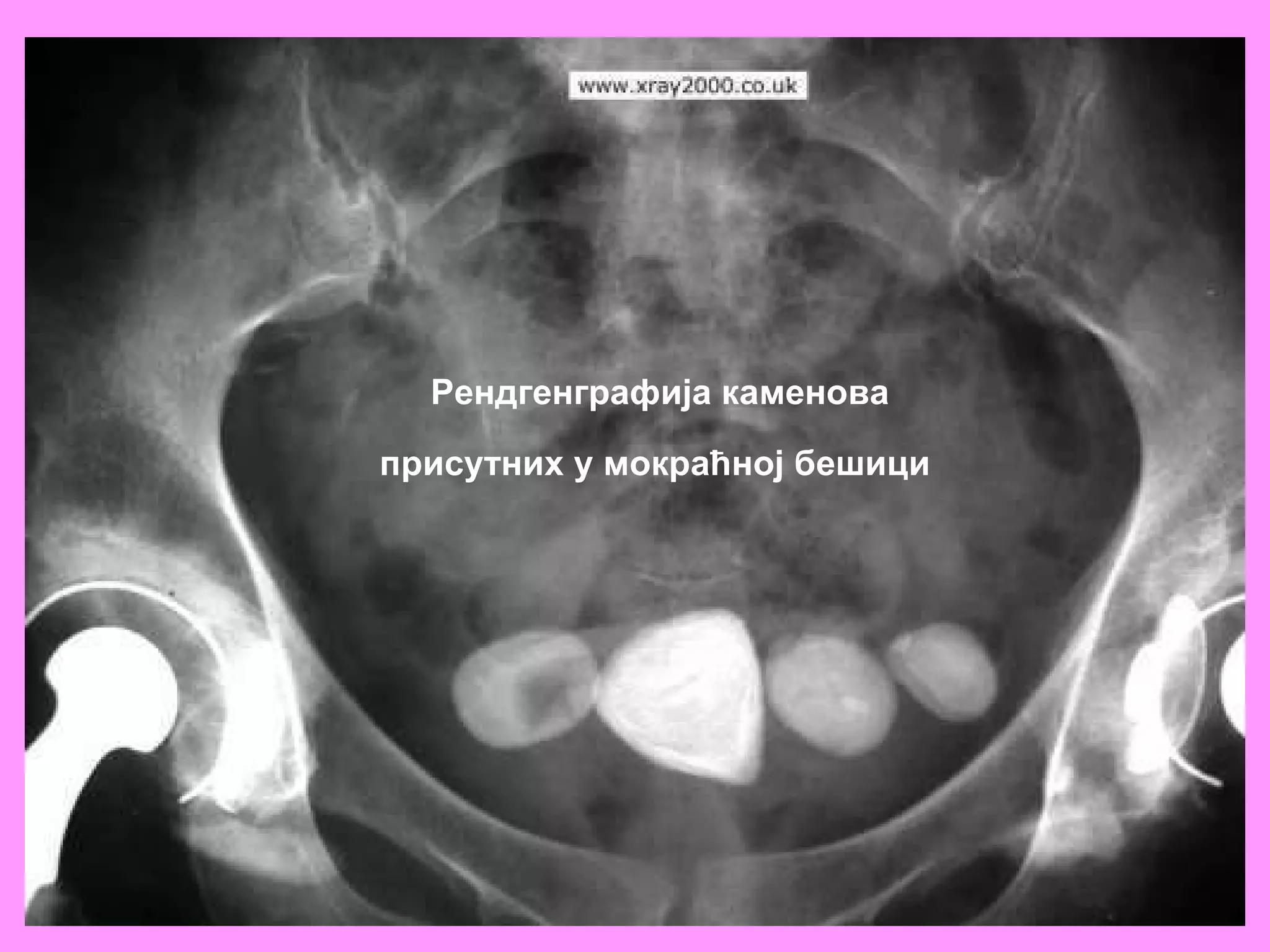Рендгенграфија каменова  присутних у мокраћној бешици   