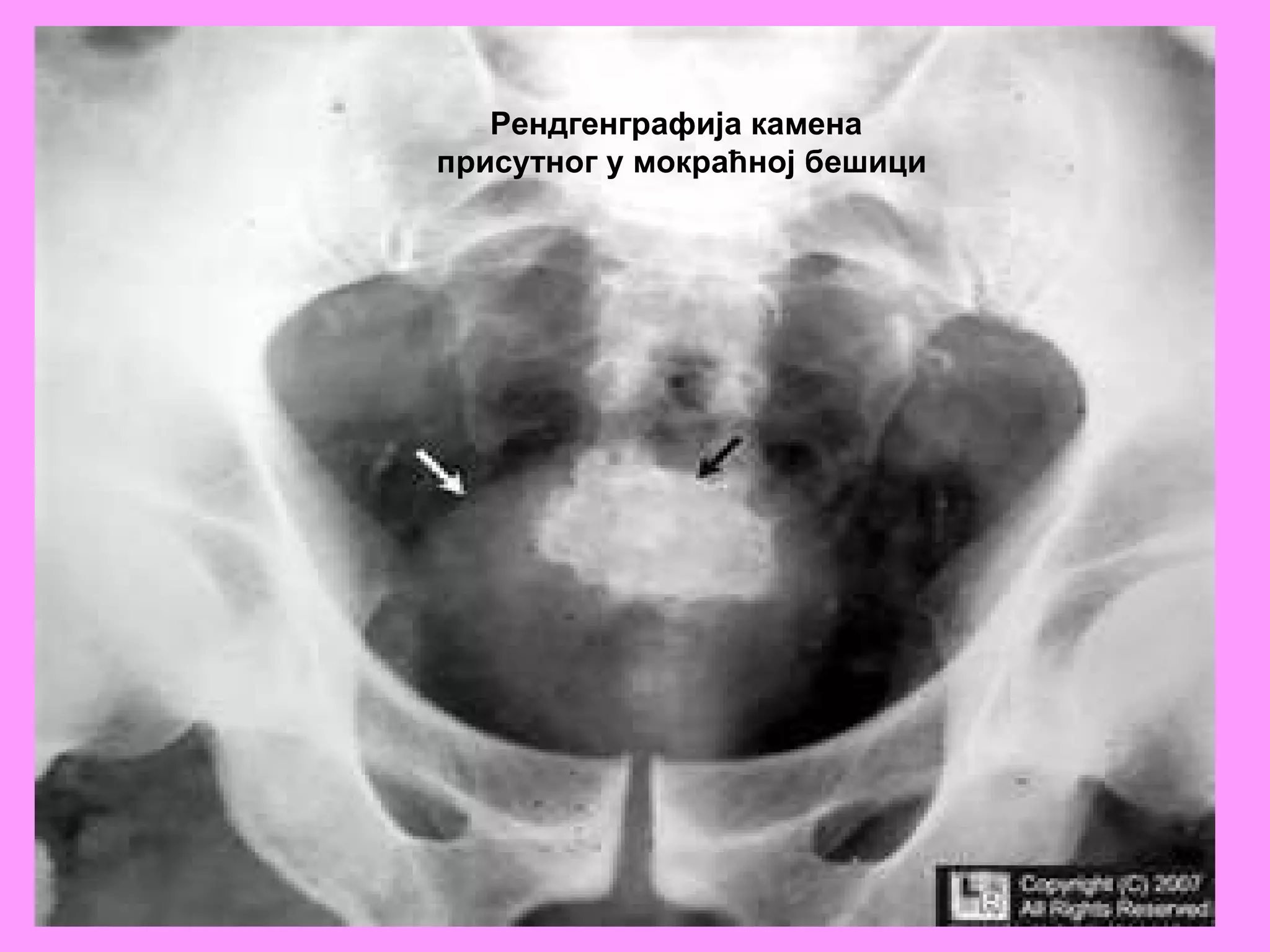 Рендгенграфија камена присутног у мокраћној бешици 