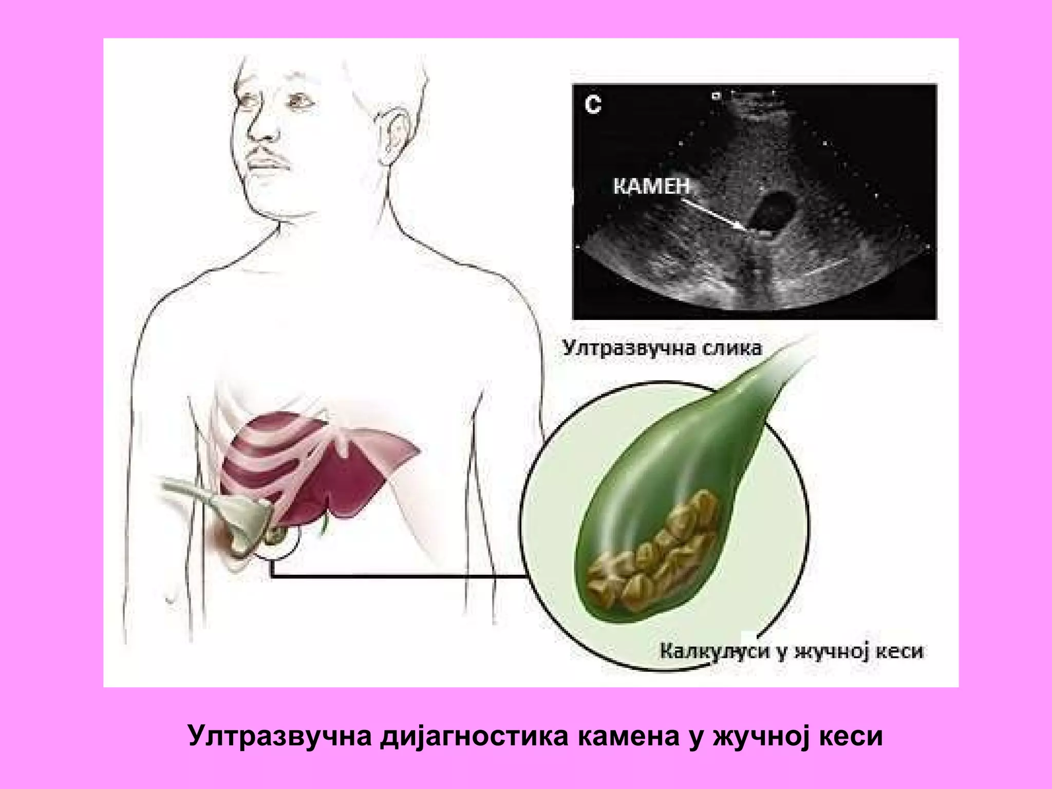 Ултразвучна дијагностика камена у жучној кеси   