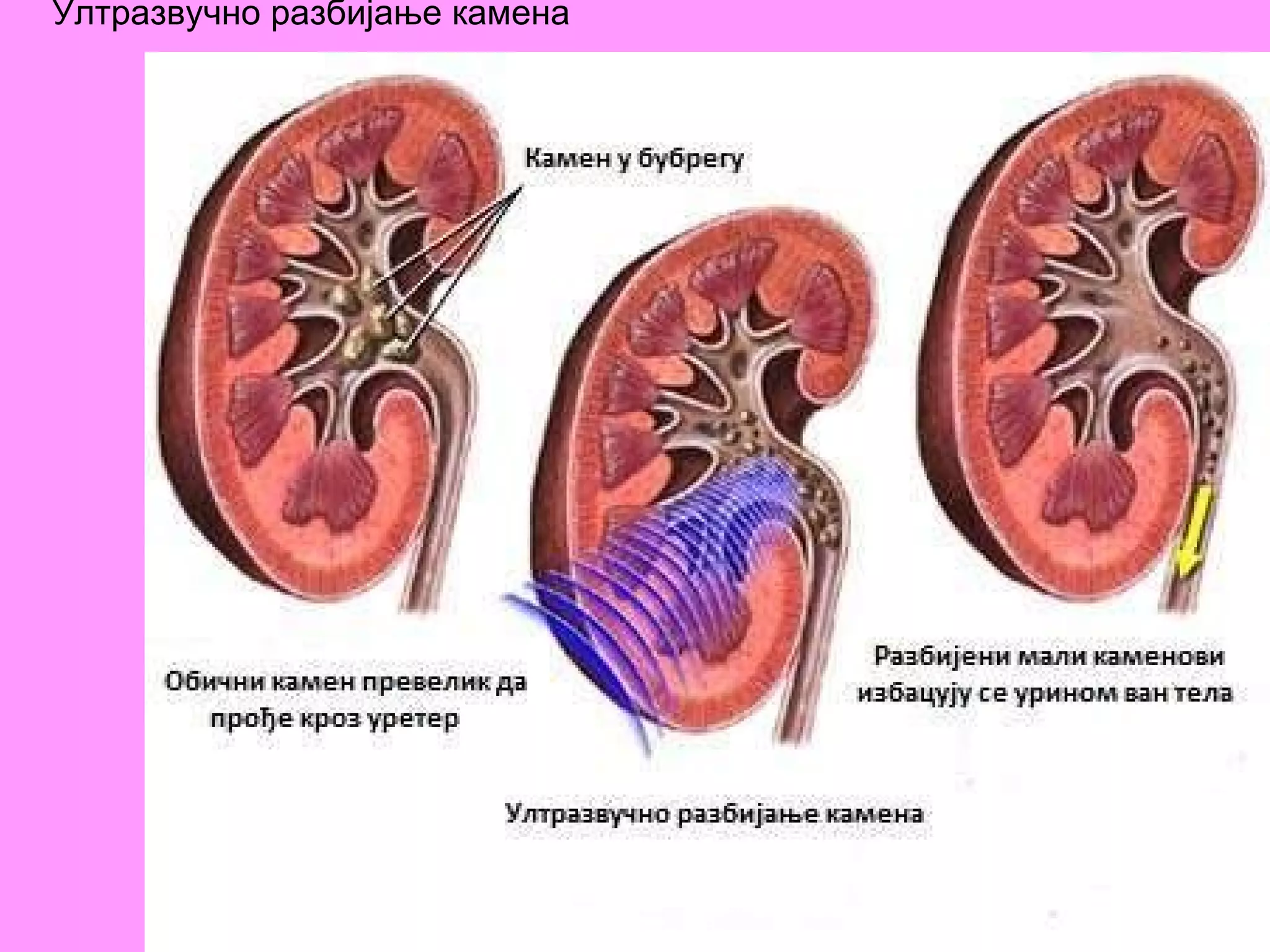 Ултразвучно разбијање камена   
