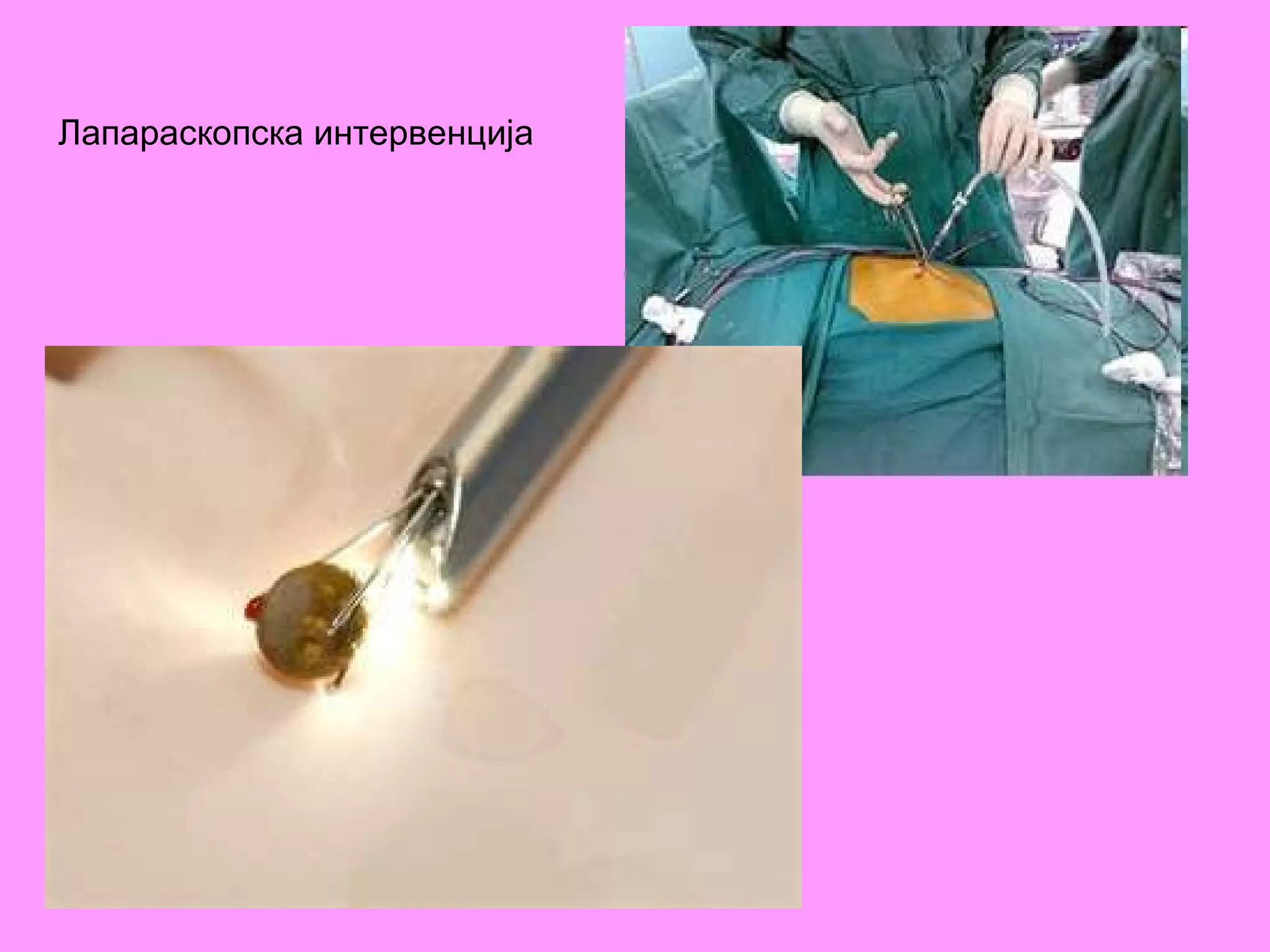 Лапараскопска интервенција   