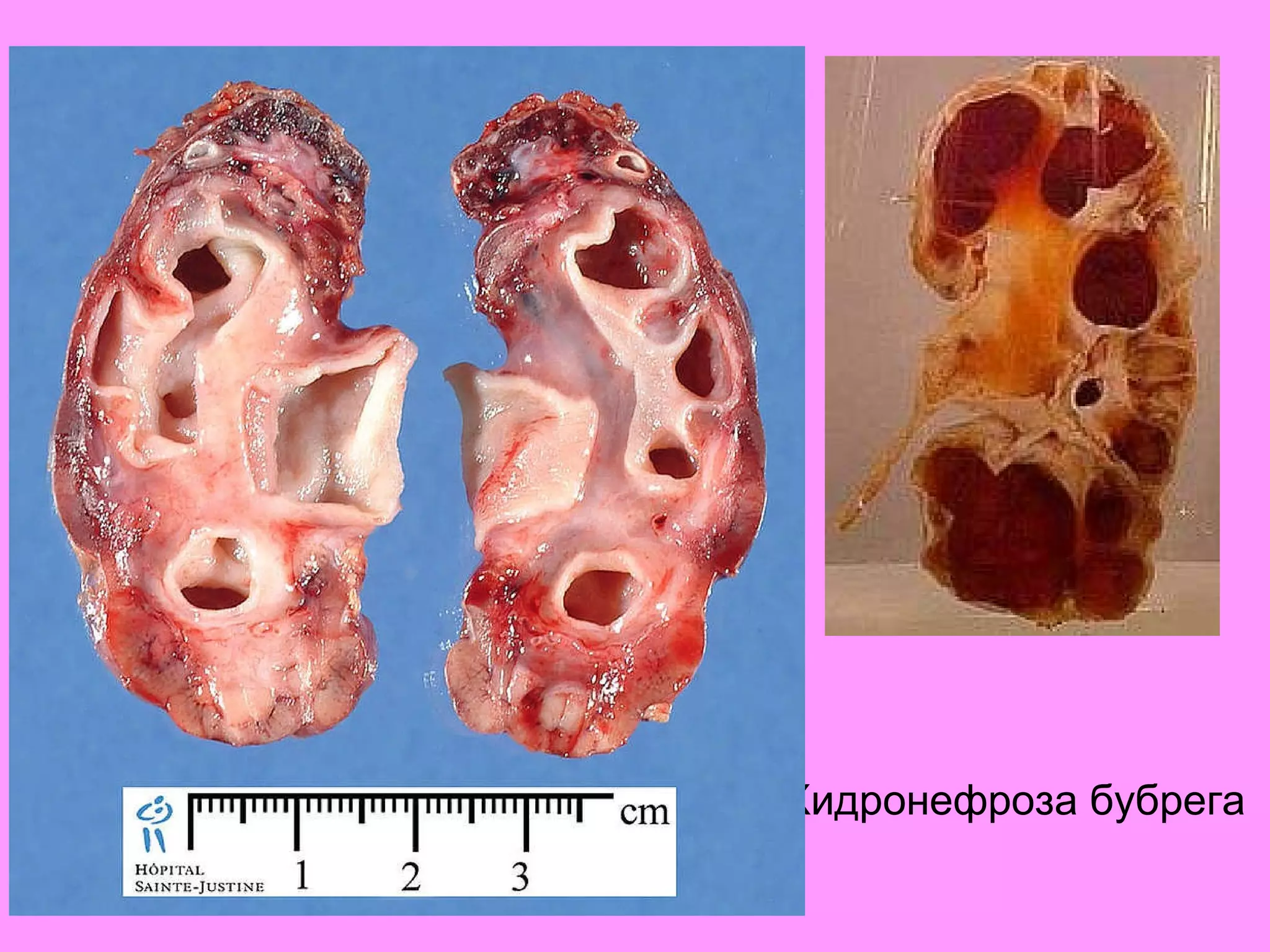 Хидронефроза бубрега 