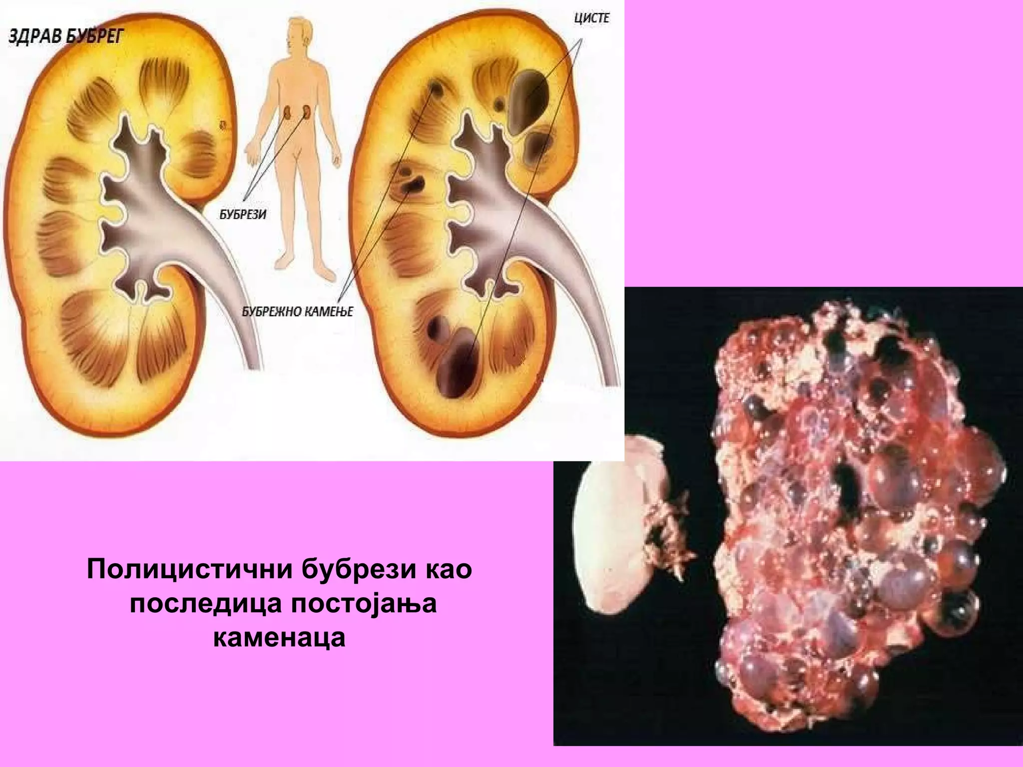 Полицистични бубрези као последица постојања каменаца 