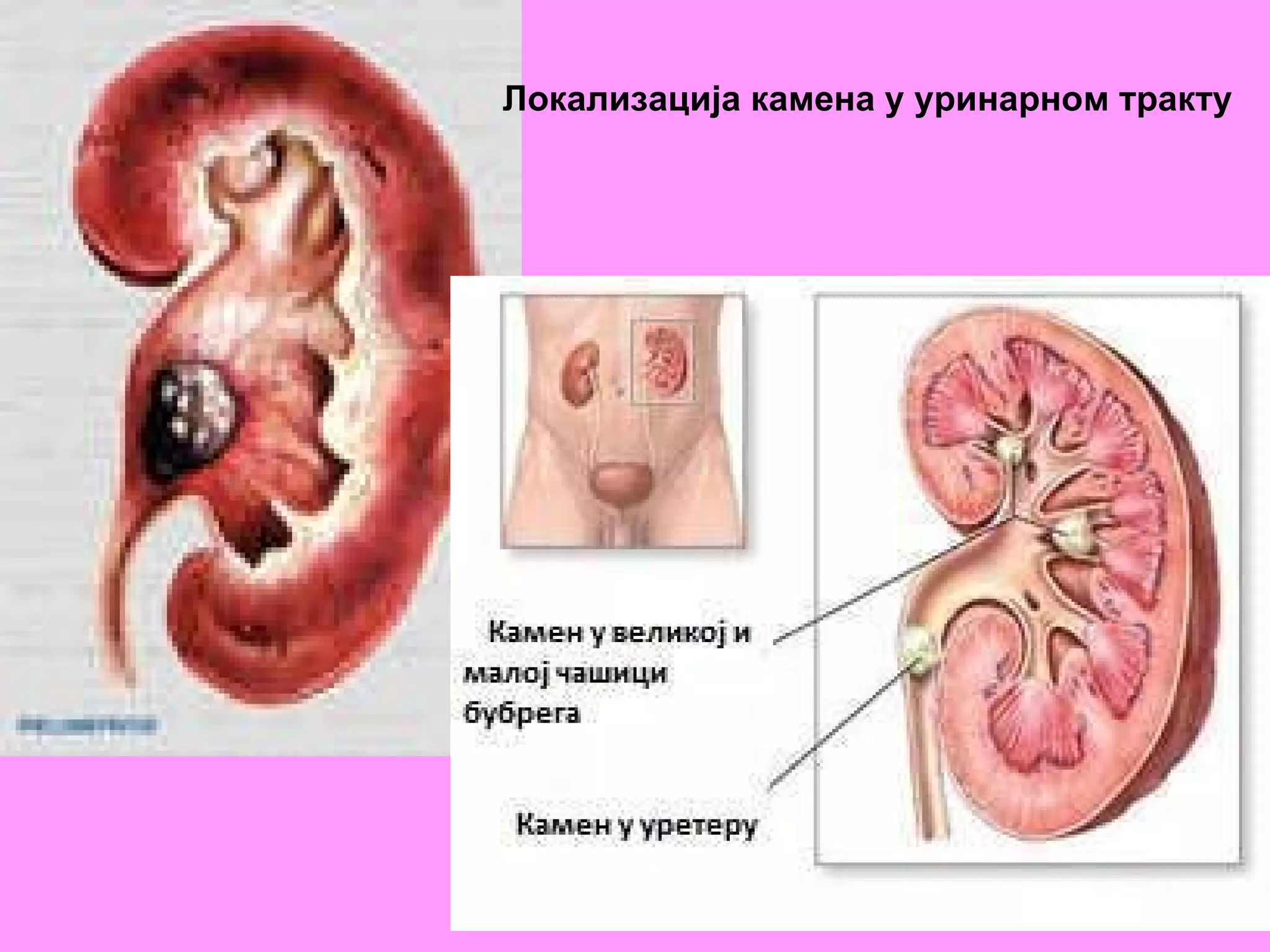 Локализација камена у уринарном тракту   