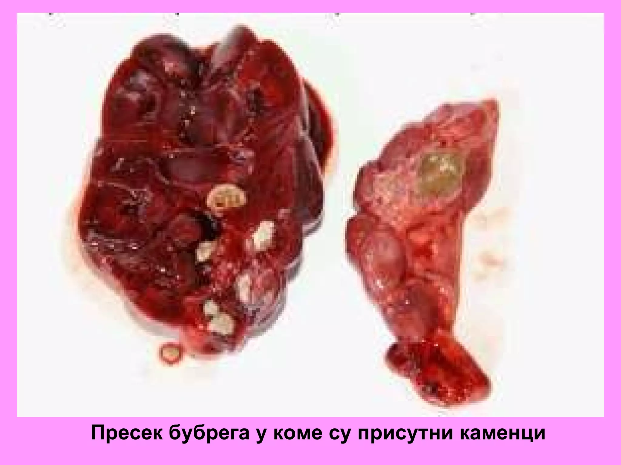 Пресек бубрега у коме су присутни каменци 