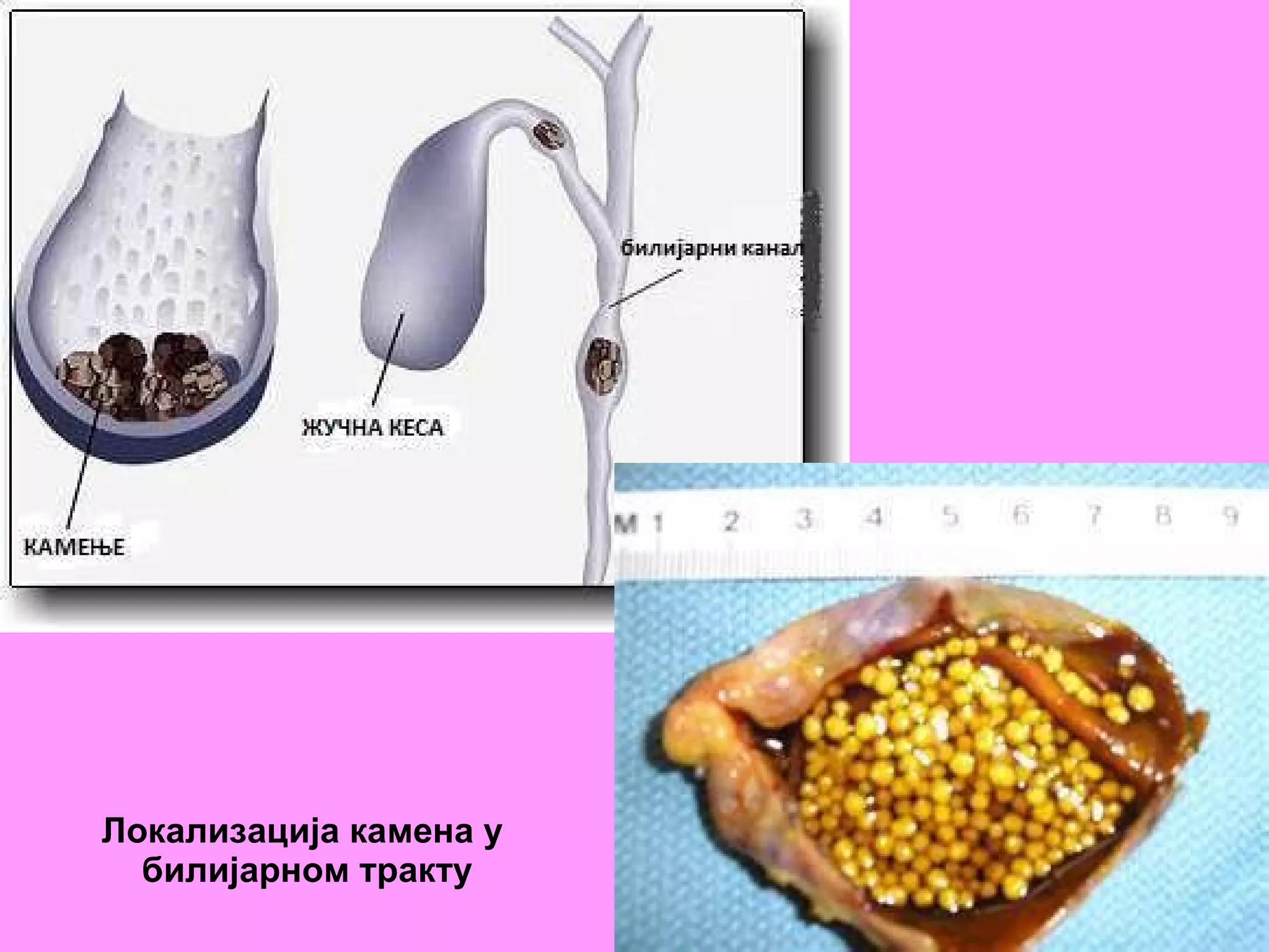 Локализација камена у  билијарном тракту 