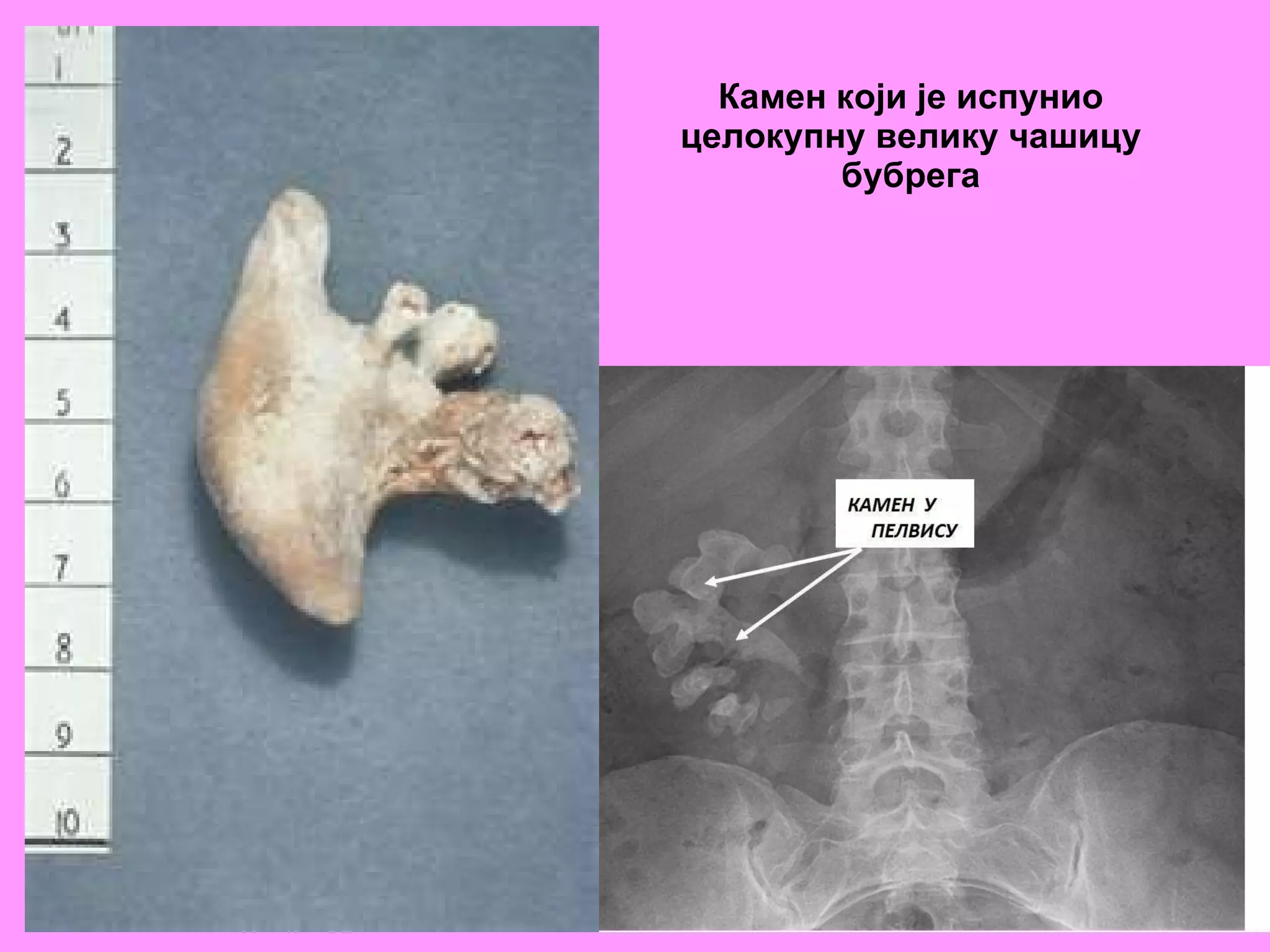 Камен који је испунио целокупну велику чашицу бубрега 