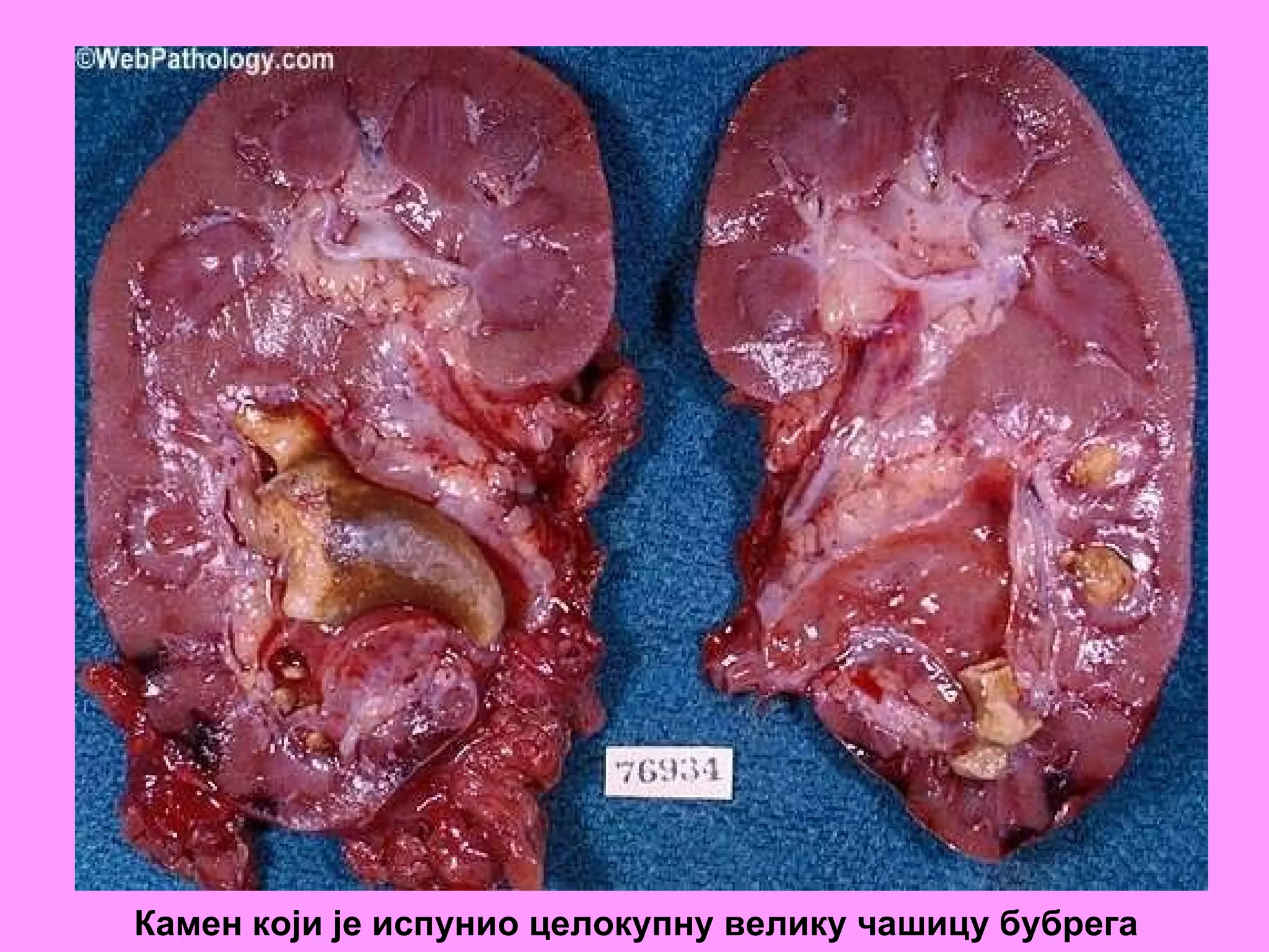 Камен који је испунио целокупну велику чашицу бубрега 