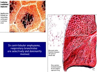 In centrilobular emphysema,  respiratory bronchioles  are selectively and dominantly involved. 