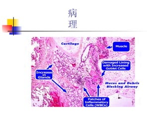 病  理 