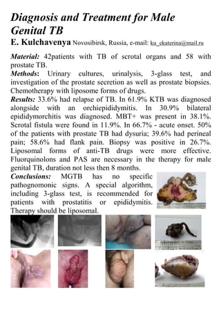 Diagnosis and Treatment for Male
Genital TB
E. Kulchavenya Novosibirsk, Russia, e-mail: ku_ekaterina@mail.ru
Material: 42patients with TB of scrotal organs and 58 with
prostate TB.
Methods: Urinary cultures, urinalysis, 3-glass test, and
investigation of the prostate secretion as well as prostate biopsies.
Chemotherapy with liposome forms of drugs.
Results: 33.6% had relapse of TB. In 61.9% KTB was diagnosed
alongside with an orchiepididymitis. In 30.9% bilateral
epididymorchitis was diagnosed. MBT+ was present in 38.1%.
Scrotal fistula were found in 11.9%. In 66.7% - acute onset. 50%
of the patients with prostate TB had dysuria; 39.6% had perineal
pain; 58.6% had flank pain. Biopsy was positive in 26.7%.
Liposomal forms of anti-TB drugs were more effective.
Fluorquinolons and PAS are necessary in the therapy for male
genital TB, duration not less then 8 months.
Conclusions: MGTB has no specific
pathognomonic signs. A special algorithm,
including 3-glass test, is recommended for
patients with prostatitis or epididymitis.
Therapy should be liposomal.
 