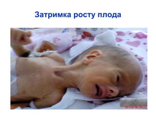 Затримка росту плода 