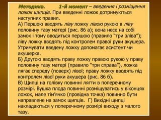 Методика. 1-й момент  – введення і розміщення ложок щипців.  При введенні ложок дотримуються наступних правил. А) Першою вводять  ліву  ложку  лівою  рукою в  ліву  половину тазу матері (рис.  86  а); вона несе на собі замок і тому вводиться першою (правило “три зліва”); ліву ложку вводять під контролем правої руки акушера. Утримувати введену ложку допомагає асистент чи акушерка. Б) Другою вводять праву ложку правою рукою у праву половину тазу матері (правило “три справа”), ложка лягає спереду (поверх) лівої; праву ложку вводять під контролем лівої руки акушера (рис.  86  б). В) Щипці на голівку повинні лягти в поперечному розмірі. Вушка плода повинні розміщуватись у віконцях ложок, мале тім’ячко (провідна точка) повинно бути направлене на замок щипців.   Г) Вихідні щипці накладаються у поперечному розмірі виходу з малого тазу. 